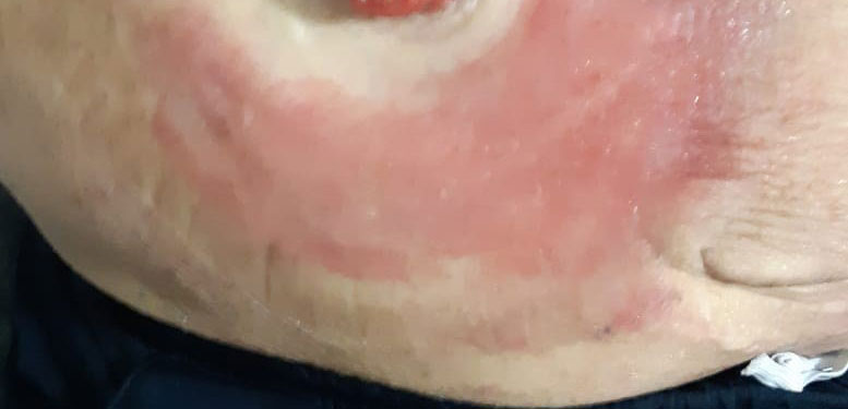 סטומה-גירוי עור